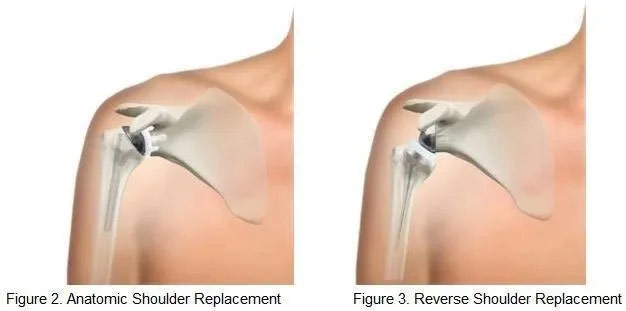 shoulder joint diagram